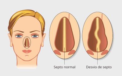 Desvio de Septo Nasal